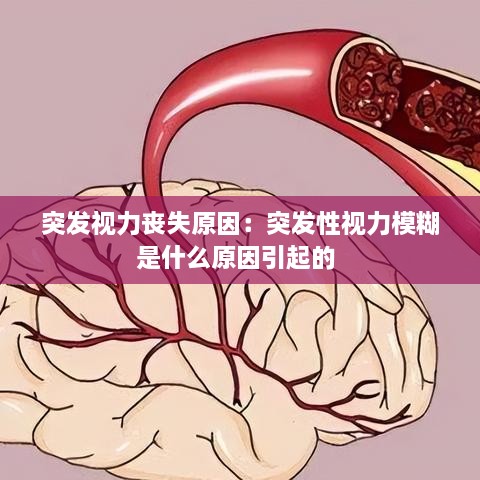 突发视力丧失原因：突发性视力模糊是什么原因引起的 